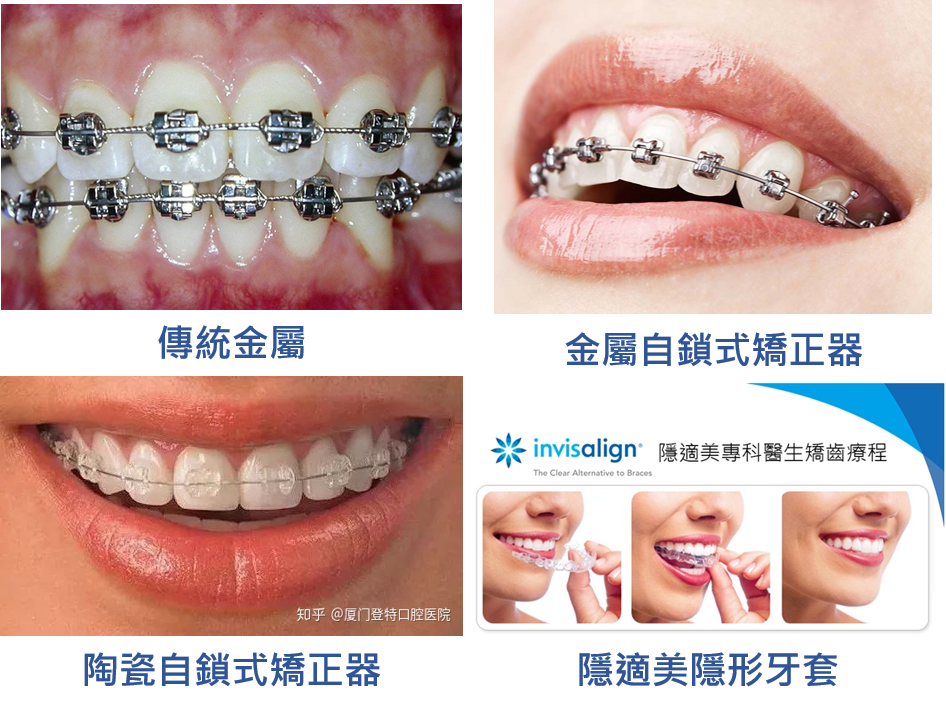 四種牙齒矯正器