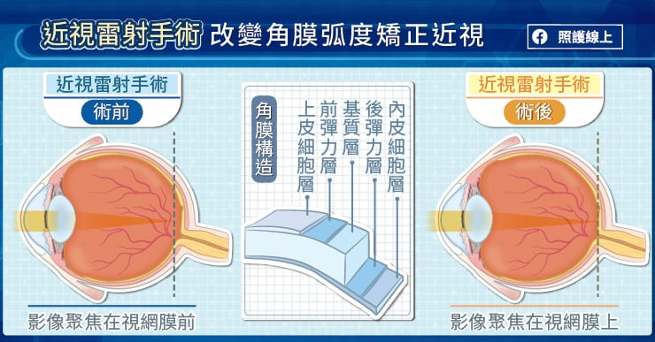 雷射手術